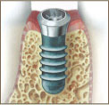 インプラント体の埋入と治癒