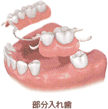 部分入れ歯