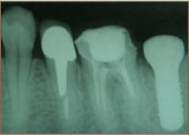 インプラント手術後のレントゲン