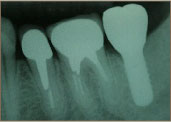 インプラント上部構造装着後のレントゲン