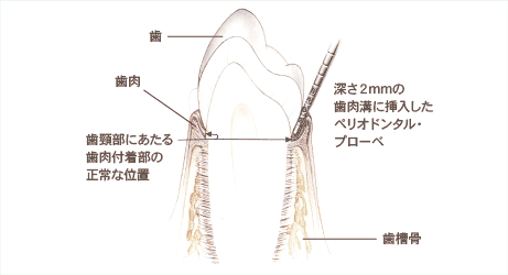 健康な歯周組織：歯と歯肉（歯ぐき）の間には2mmほどのすき間があります。