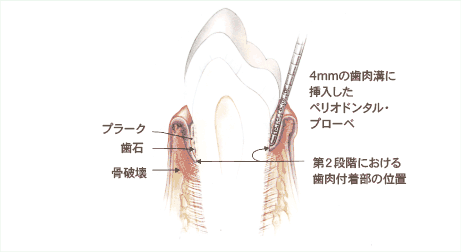 食べかすと歯周病菌からなるプラークが石灰化し歯石が形成されます。