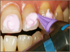歯の隣接面の清掃研磨